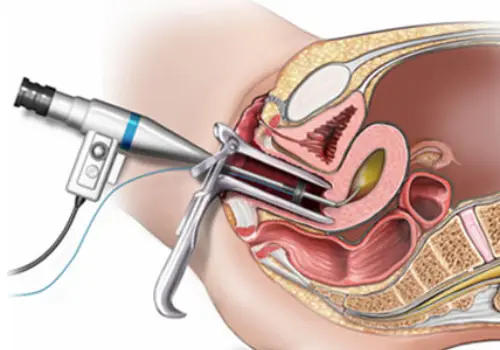 Hysteroscopy Guided D&C in Noida | Dr. Mandavi Rai – Expert Gynecologist