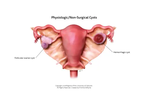 Ovarian Cyst Treatment in Noida | Dr. Mandavi Rai – Laparoscopic Specialist