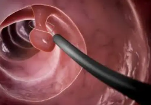 Polypectomy in Noida | Dr. Mandavi Rai – Expert in Uterine Polyp Removal