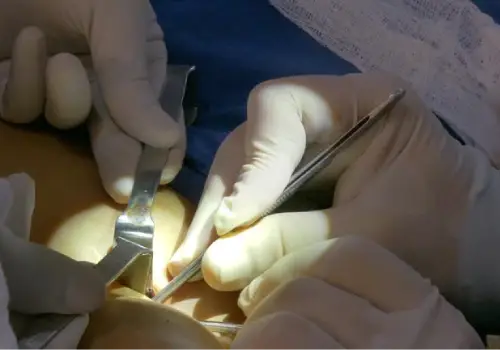 Septal Removal Surgery in Noida | Dr. Mandavi Rai – Uterine Septum Expert