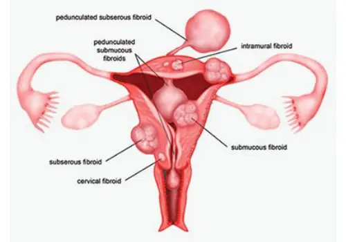 Uterine Fibroids Treatment in Noida | Dr. Mandavi Rai – Laparoscopic Specialist
