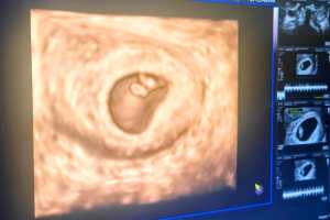 Anuradha IVF Case Study